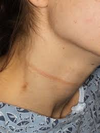 Necklace Strangle Marks